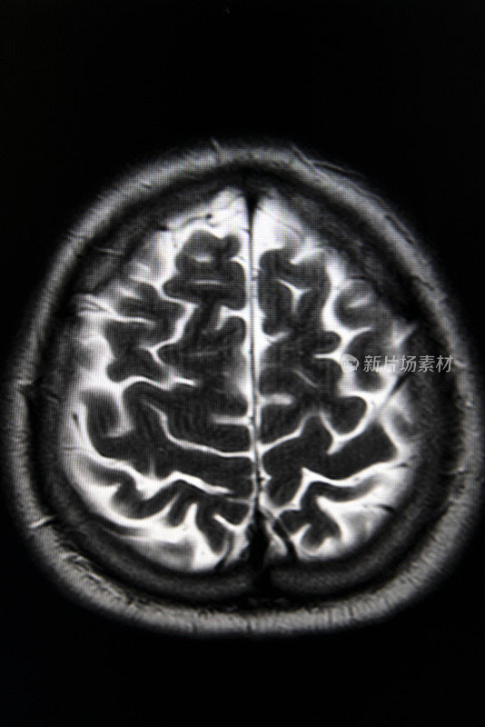 大脑的磁共振成像(MRI brain)。